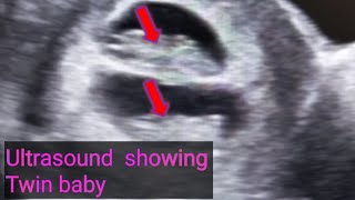 Ultrasound showing Twin Baby at  8 week @sumeshradiology