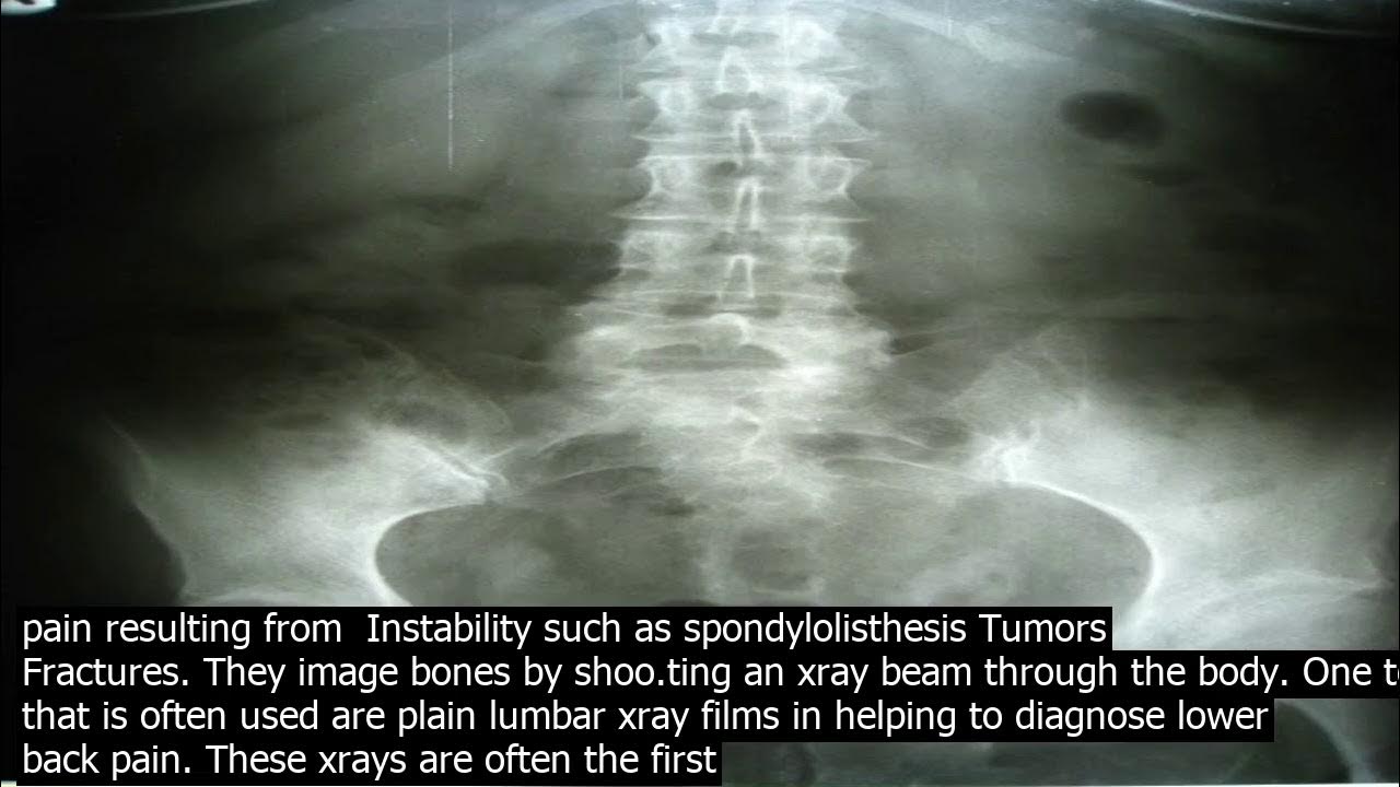 Lower back pain x ray results according to the mayo clinic a lumbar