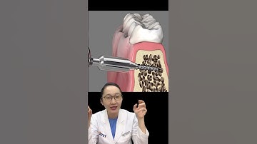 Các bước Bác sĩ sẽ cắm vis cho bạn #shorts