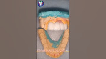 Ceramic Teeth | Upper Anterior | Maxillary Insicor | PFM | Tamil Dental Lab | #tamildentist #shorts🦷