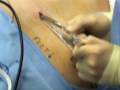 Part 1 - Right Laparoscopic Radical Nephrectomy