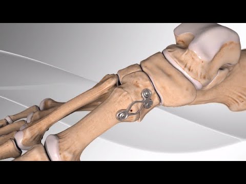 Video: Wat is tarsometatarsale osteoartritis?