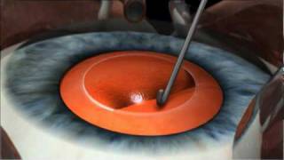 Phacoemulsification Cataract Surgery