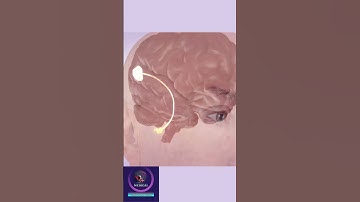 Tinnitus, Ringing in the ears #shorts #education