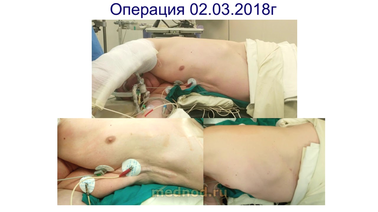 Рак легкого имитировал доброкачественную опухоль. Однопортовое удаление левого легкого.