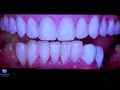 Reabilitação Bucal Completa - implantes e dentes de porcelana