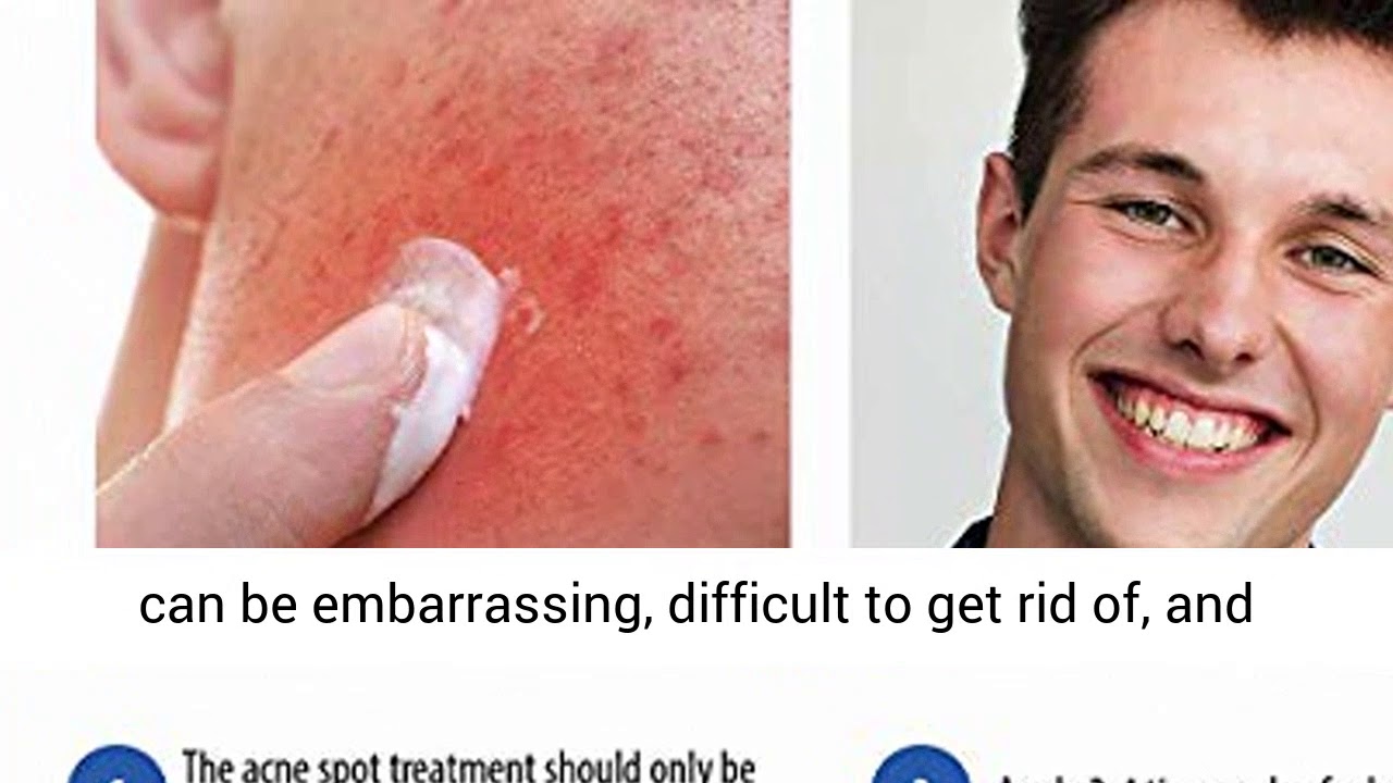 puriderma acne spot treatment