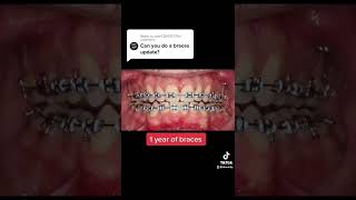 1 year of BRACES timelapse