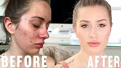 My 'Go To' Makeup for ACNE FLARE UPS
