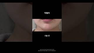 턱필러로 V라인 만든 후기 #shortvideo #shorts
