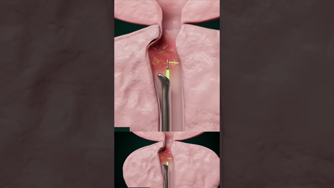 Аденома простаты. Операция. #уролог #урология