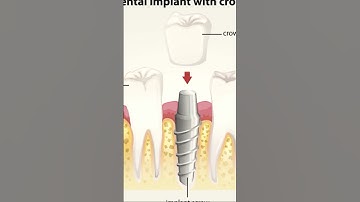 Dental implants can help you improve your smile, confidence, and overall quality of life.