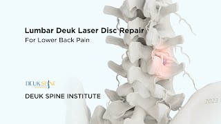 How to CURE Discogenic Lower Back Pain with the Deuk Laser Disc Repair - (3D Animation) by Deuk Spine Institute 765 views 1 month ago 1 minute, 8 seconds