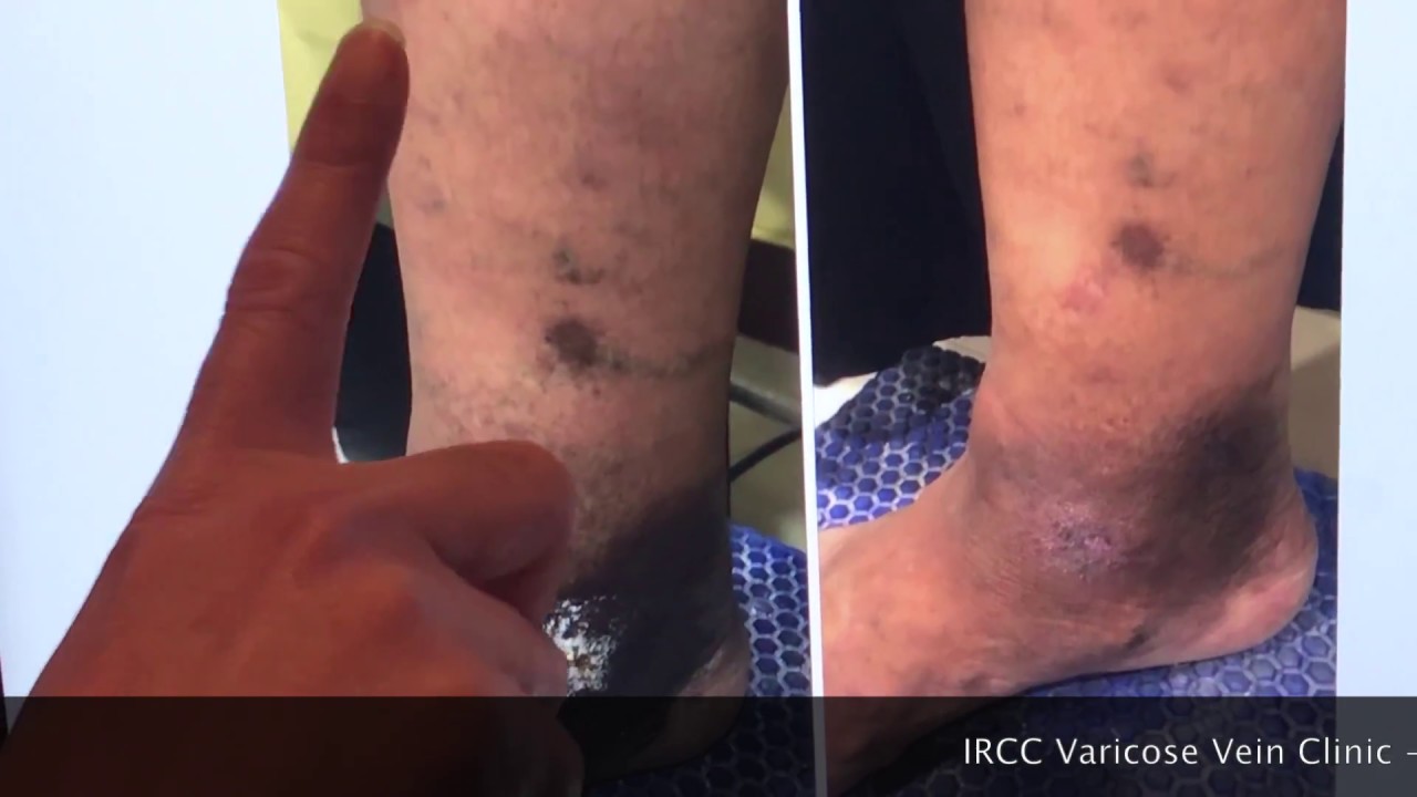 Karachi Lahore Rawalpindi IRCC Varicose Vein Clinic Pakistan invasive ductal carcinoma
