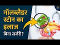बिना आपरेशन पित्त की पथरी का इलाज? | Can You Treat Gallstone without Surgery?