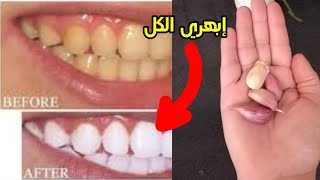 Teeth whitening and gum  تبييض الأسنان في المنزلtreatment