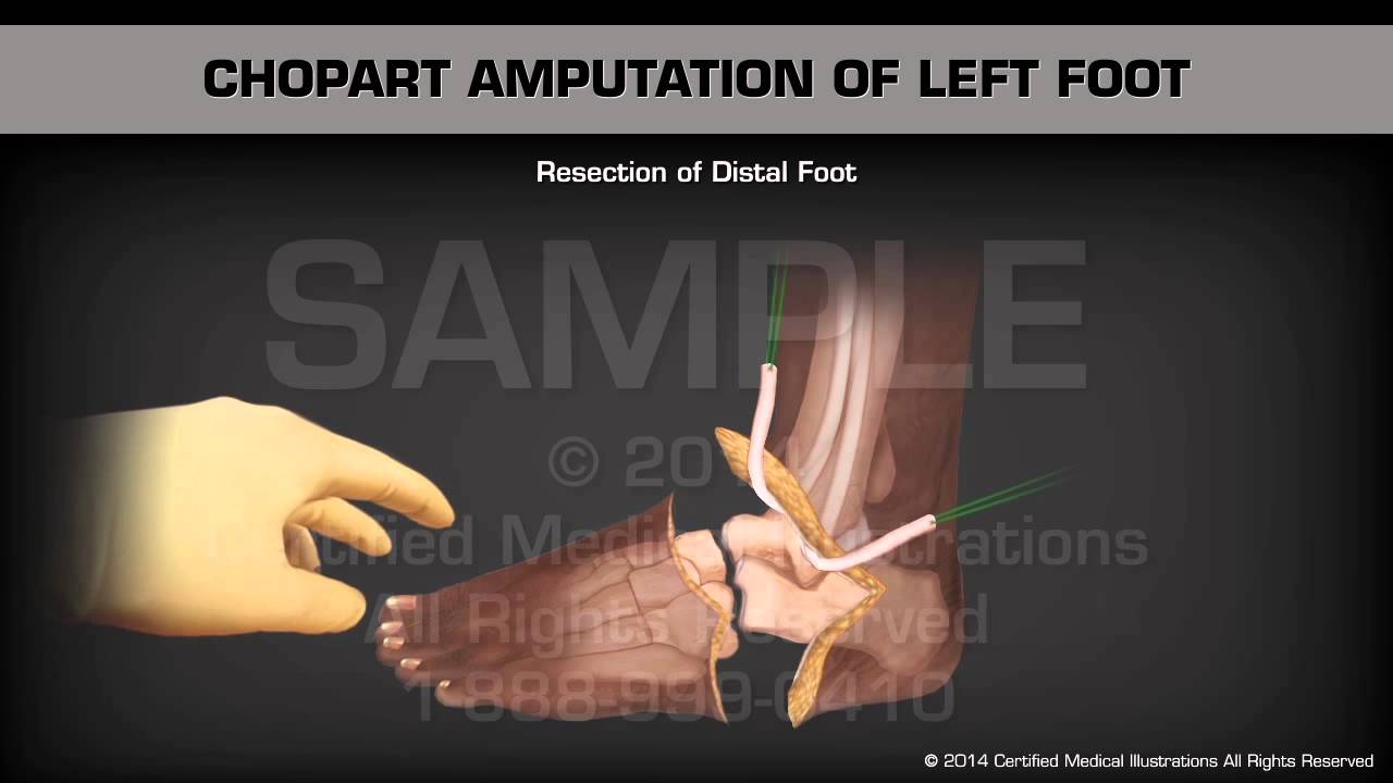 Chopart Amputation LeftFoot - YouTube
