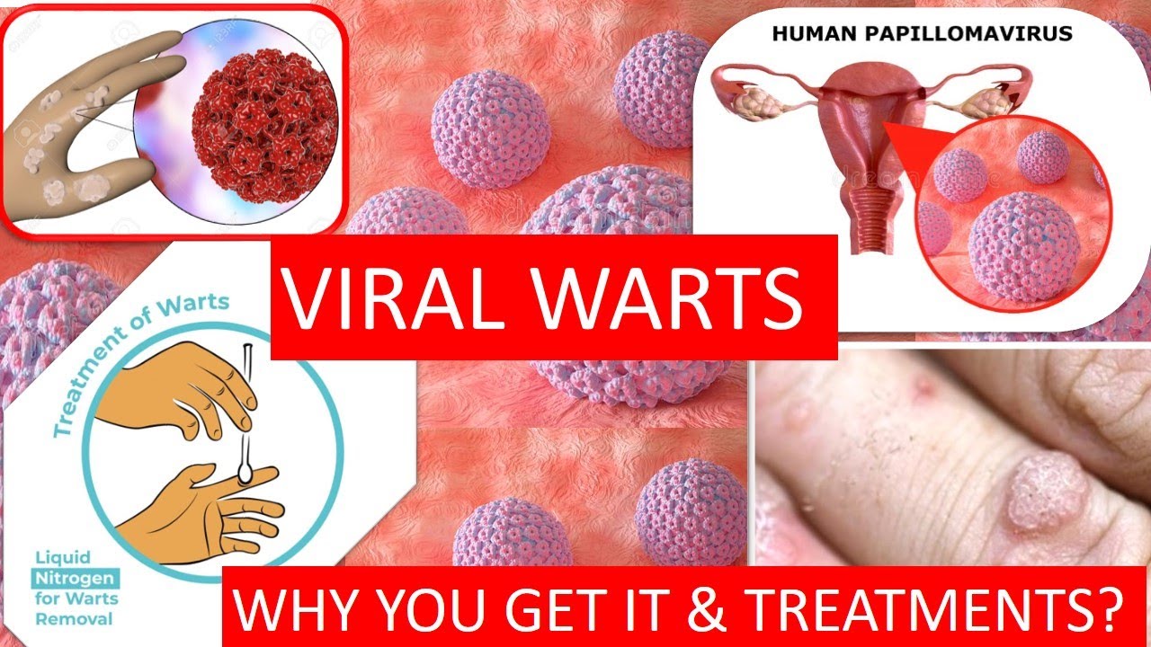 What are WARTS (HPV) ? - 3D Medical Animation