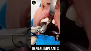 How are dental implants done on front teeth  dentalwork dentistry shortsvideo dentist viral
