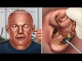 ASMR 아~주 오래된 만두귀 왕귀지 제거 애니메이션 | 귀청소 | Very Old Cauliflower Ear Wax Removal Animation | Ear Cleaning