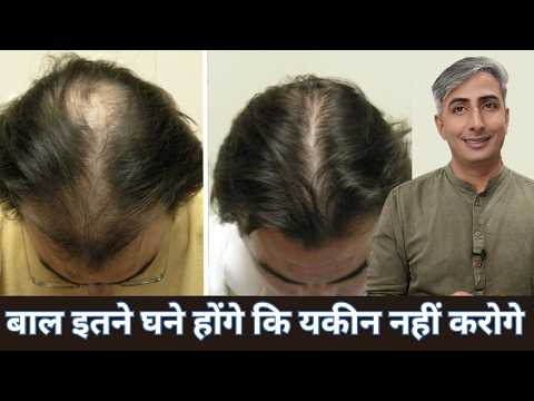 बाल ऐसे बढ़ेंगे जैसे जादू I बाल बढ़ेंगे 8 गुना तेज़ I DR. MANOJ DAS I #drmanojdas #drmanojdasjaipur