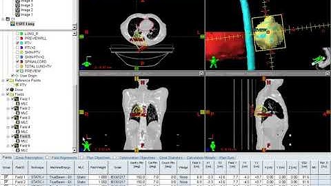 4 Beam Arrangement for Lung SBRT