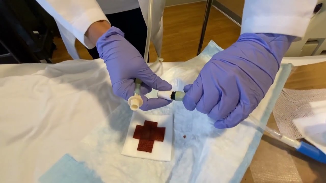 Peritoneal Dialysis: Manual Exchange