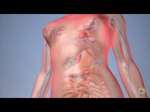 Video: ¿El colangiocarcinoma se propaga a los pulmones?