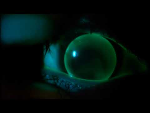 Instructional Video: Assessment of a Gas Permeable Contact Lens