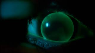 Instructional Video: Assessment of a Gas Permeable Contact Lens screenshot 5