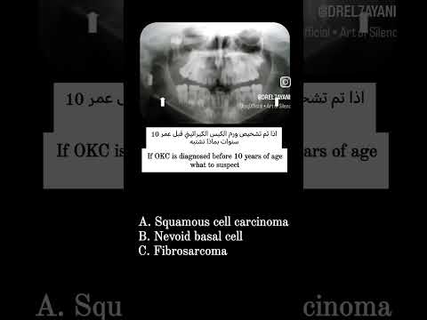 اذا تم تشخيص ورم الكيس الكيراتيني قبل عمر 10 سنوات بماذا نشتبه If OKC Is Diagnosed Before 10 Years