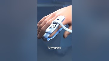 How Finger Splints Work 🤨