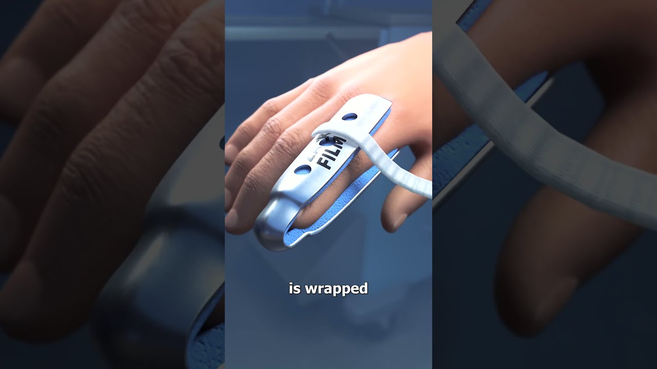 How Finger Splints Work 