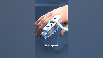 How Finger Splints Work 🤨