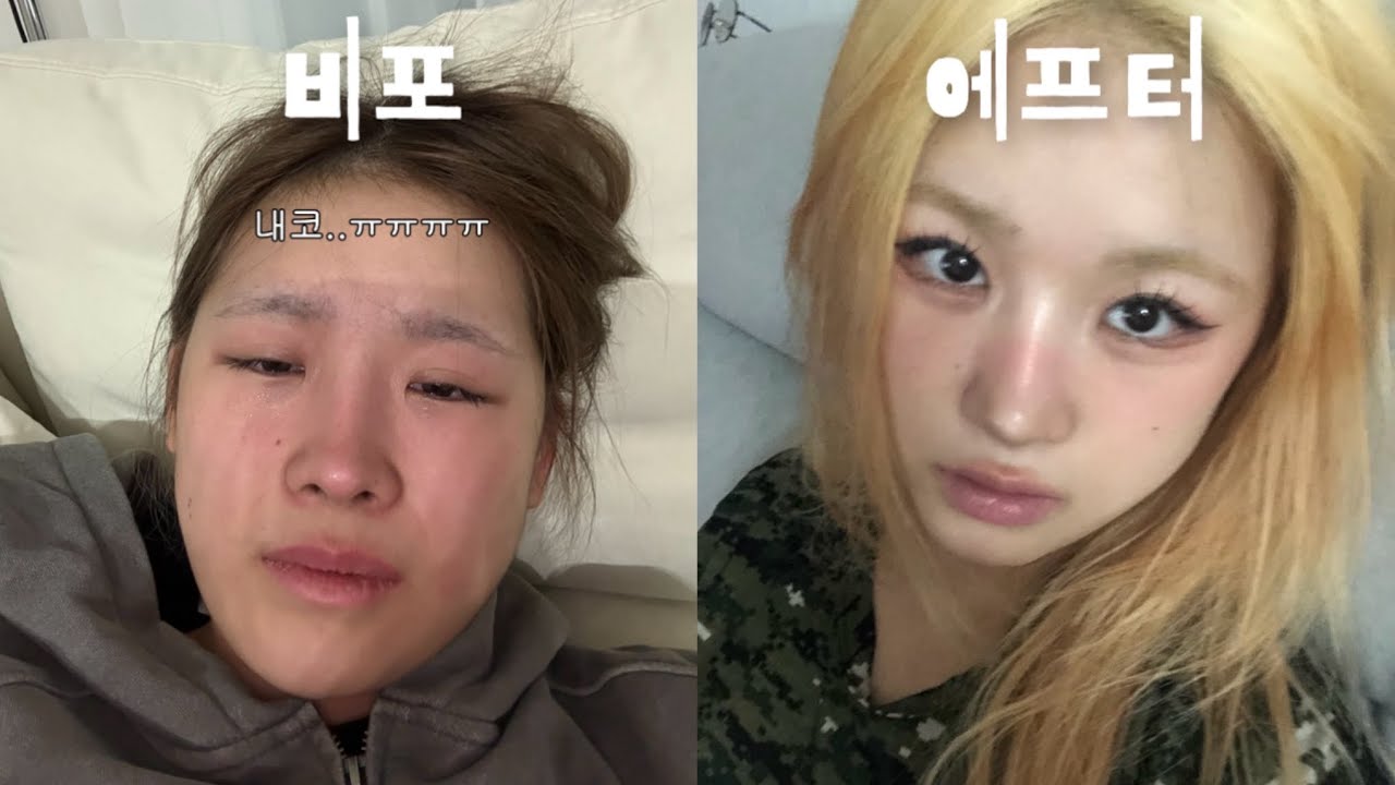 코수술3트 코재재수술 Q&A | GRWM