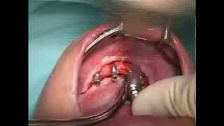 Live Operation Implantation Using A Torque Ratchet
