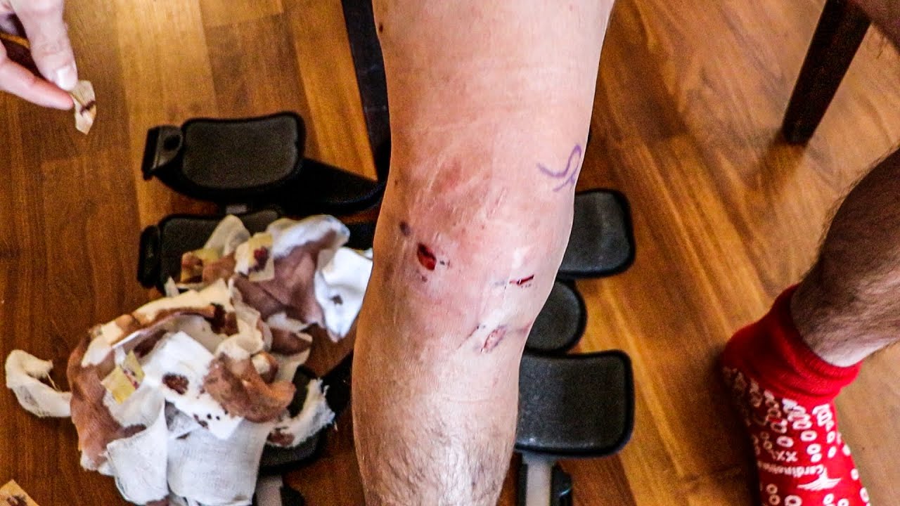 Post ACL Surgery Day 2 & 3 | Bandaged Removal