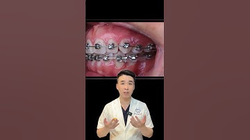 Kéo răng ngầm trong chỉnh nha #nhakhoaquocteachau #dentist #nhakhoauytin