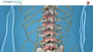 Sciatica Pain : Cause and Measures - Dr Sudheer Kumar G | Manipal Hospital Vijayawada Sciatica Pain : Cause and Measures - Dr Sudheer Kumar G | Manipal Hospital Vijayawada