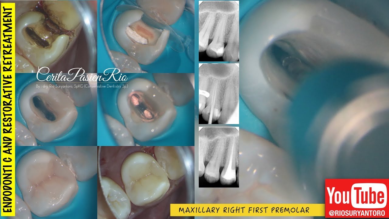 single visit endodontics