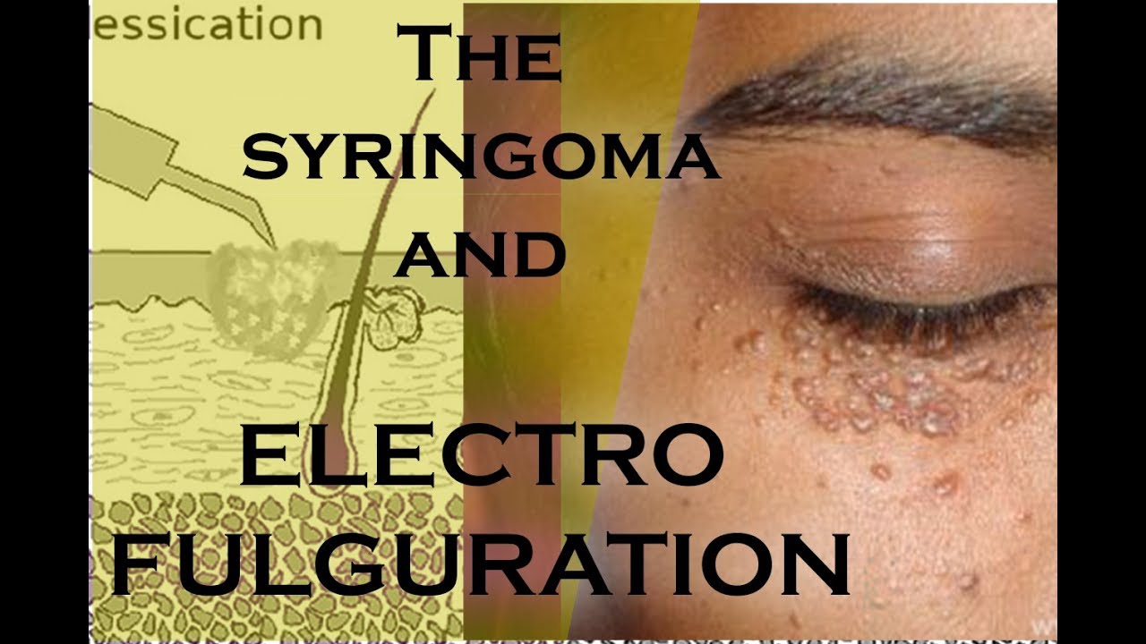 THE SYRINGOMA REMOVAL AND ELECTROFULGURATION METHOD YouTube