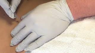 Low back pain dry needling, CORE Physical Therapy in Omaha