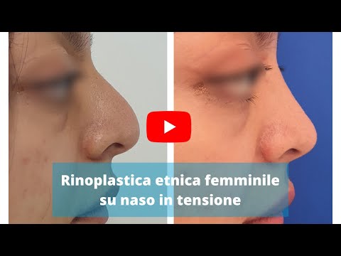 Rinoplastica etnica femminile