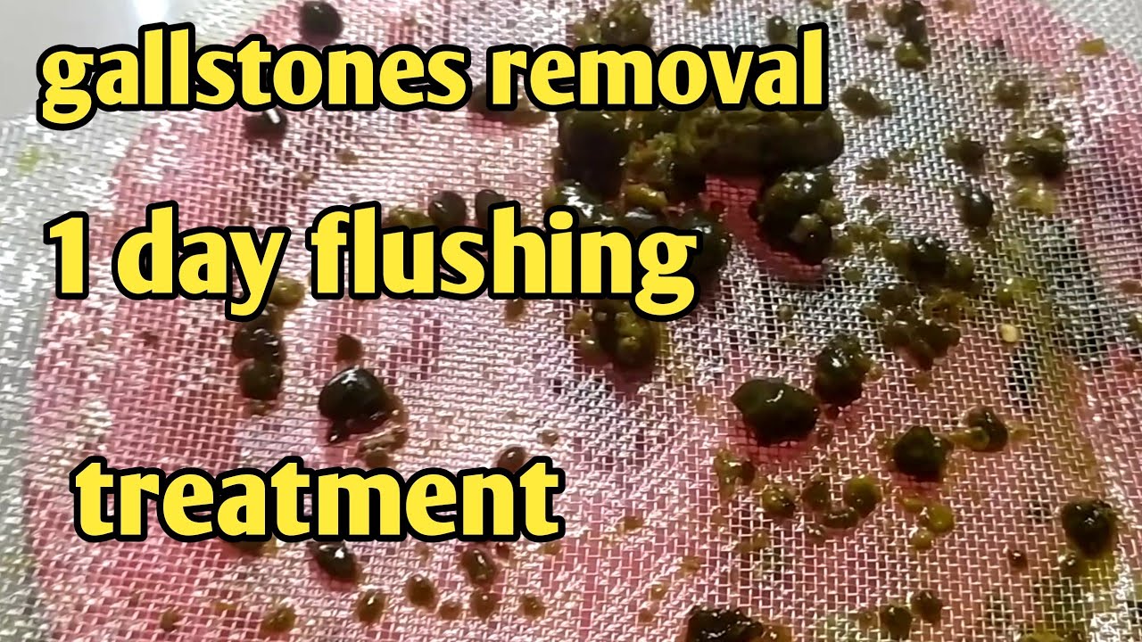 paano tanggalin ang bato sa apdo removal of gallstones 1 day flushing treatment no surgery