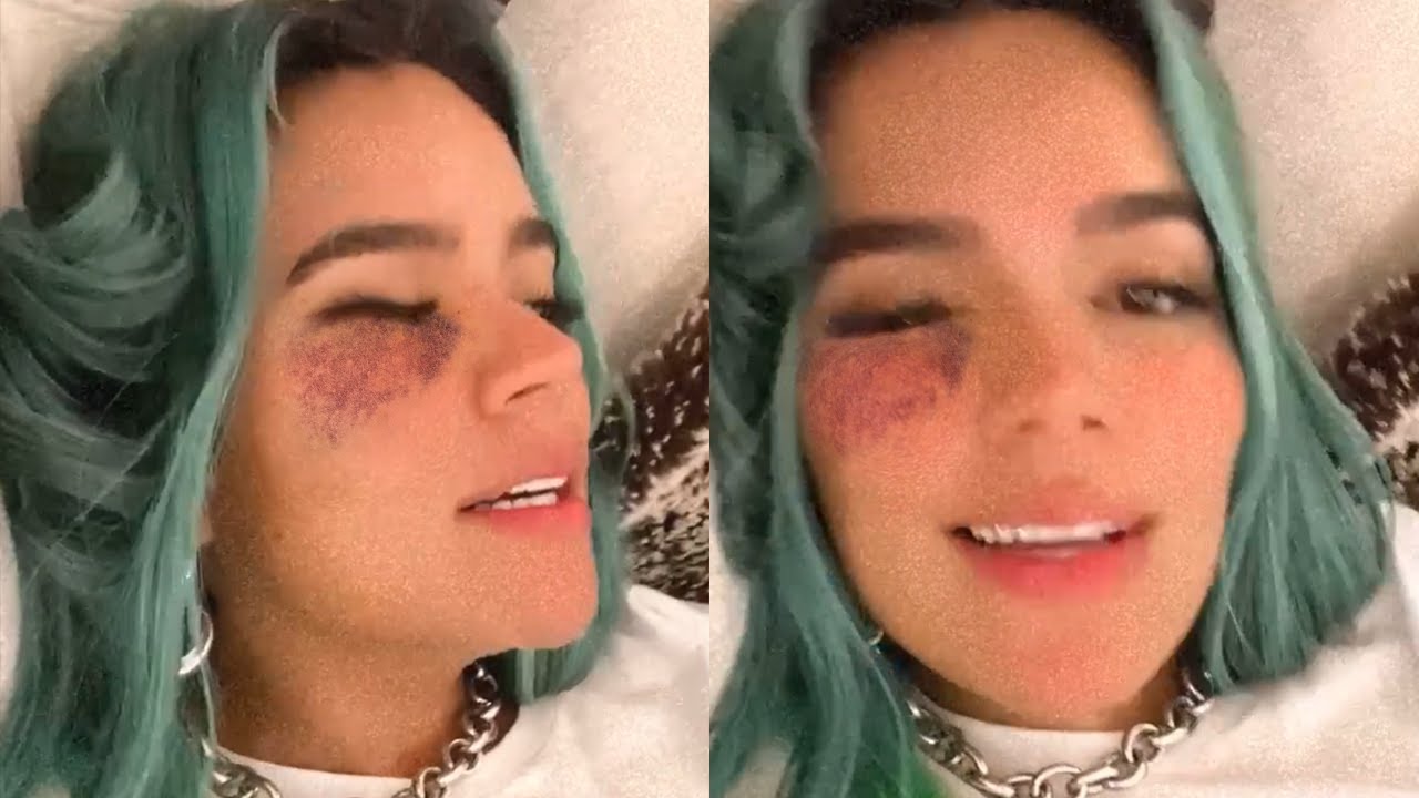 Karol G muestra las heridas que le dejó su caída en las escaleras