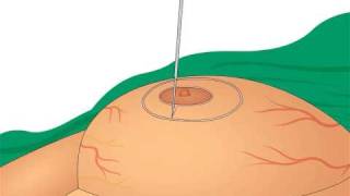 Breast Reduction Surgery - Dr Lakshmi Saleem Vertical Scar Flash