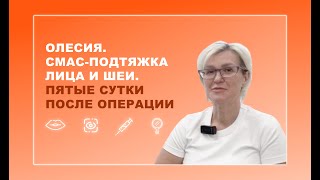 Олесия. СМАС-подтяжка лица и шеи. 5 день после операции