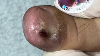 Ep_6558 *Big ingrown toenail removal 👣 โอ้โห..ทำหนูทรมานมานาน 😄 (clip from Thailand)