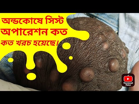 ভিডিও: এপিডারময়েড সিস্ট কি অপসারণ করা দরকার?