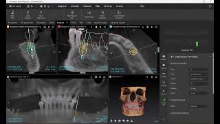 DTX Studio Clinic - Implant Planning